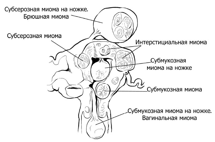 Как расположены узлы миомы матки 