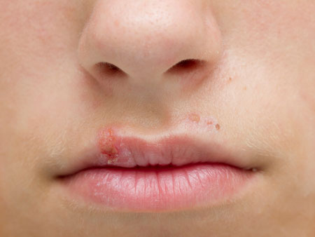 Герпес: лечение простуды на губах у ребенка 