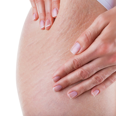 Растяжки при похудении , во время беременности : как избавиться ?