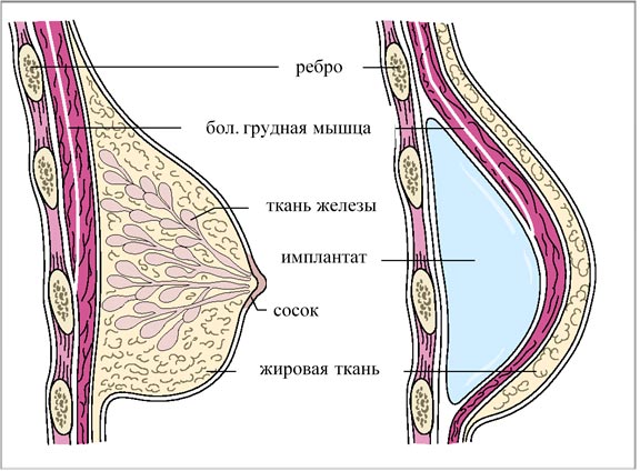 Реконструкция груди после мастэктомии : что нового 