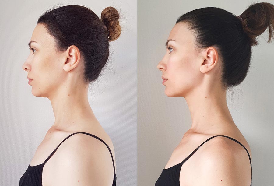 Удлинение шеи, фото о и после . Елена, 35 лет