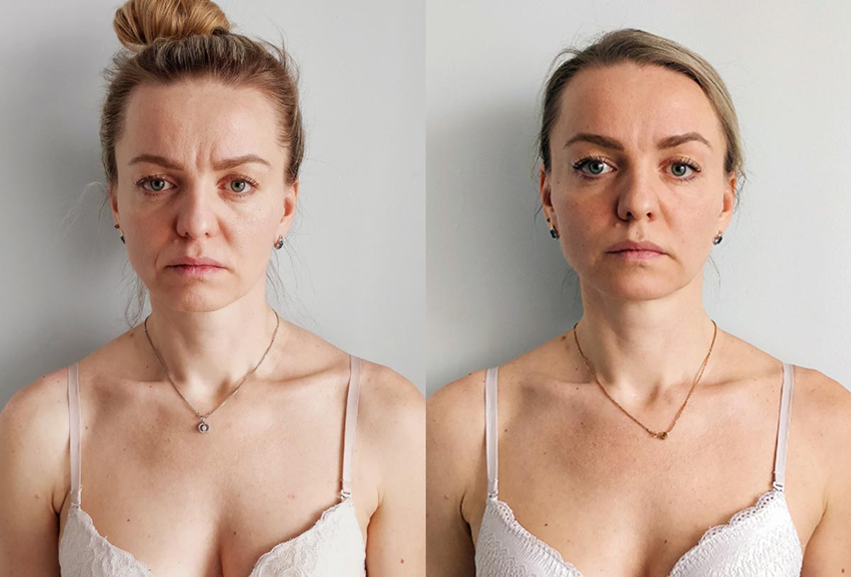 Подтяжка лица в домашних условиях , фото до и после . Светлана, 41 год