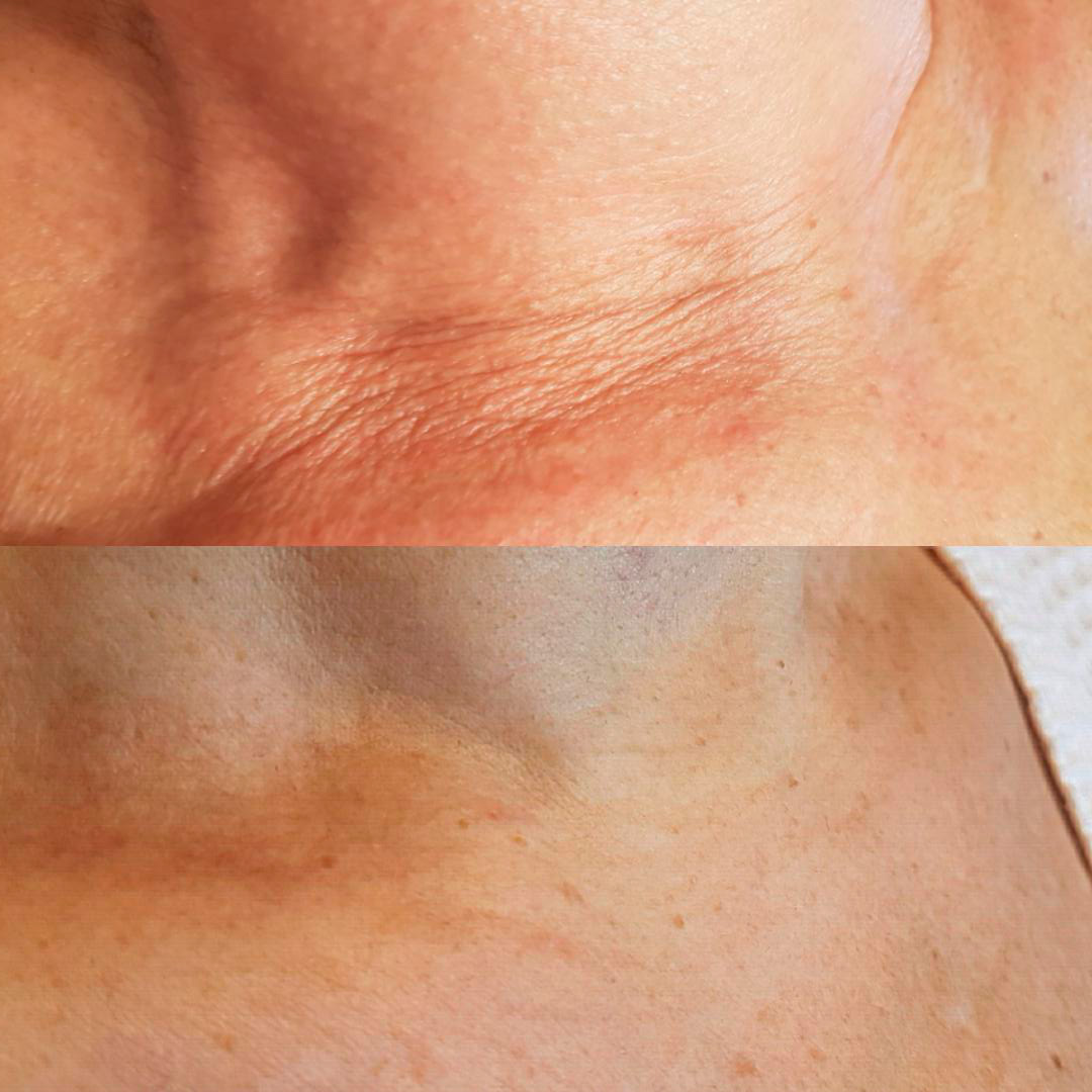Как избавиться от морщин на шее (через 2 месяца после процедуры , женщина 50+) ширина = 