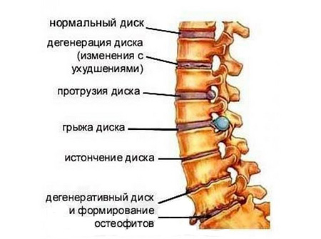 Как возникает грыжа 